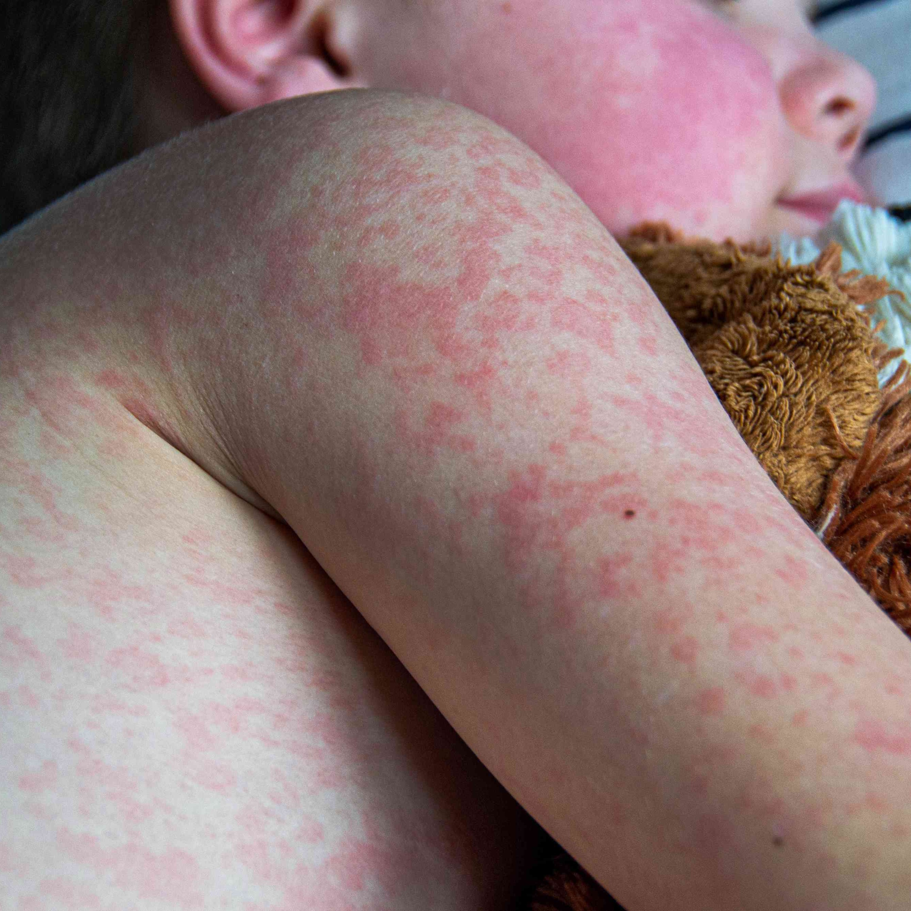 Battling Bugs: Pediatric Communicable Diseases and Vaccines episode artwork